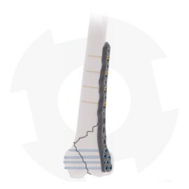 DF Distal de femur