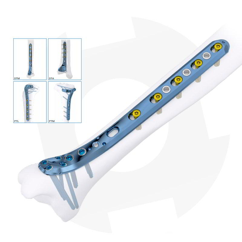 Tibia Titáneo